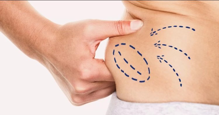 Liposuction Best Doctors in Dubai for Body Contouring and shape your Dream Body