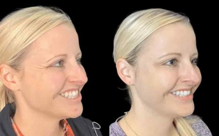 The Power of Subtle Enhancement Through Botox Treatments in Dubai