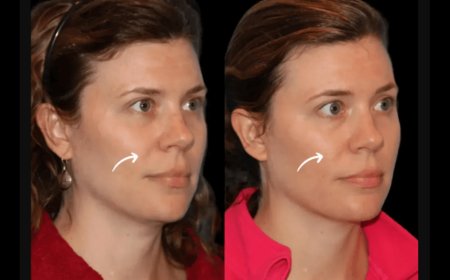 The Science Behind Sculptra Fillers: Explained by Dubai’s Best Doctors