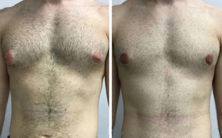 Best Plastic Surgeons for Gynecomastia in Dubai