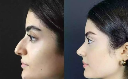 Natural Beauty Starts with the Best Rhinoplasty Surgeons in Dubai