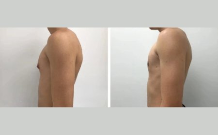 Top 5 Qualities to Look for in the Best Gynecomastia Surgeons in Dubai