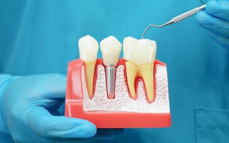 What to Expect During a Dental Crown Appointment in Garland, TX