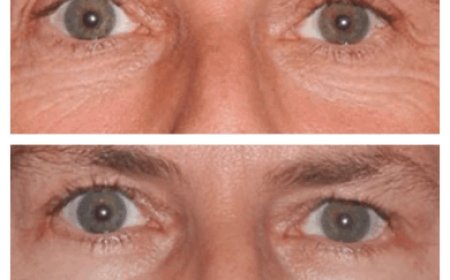 How to Choose Between Upper and Lower Eye Bag Removal: Guidance from the Best Eye bag removal Surgeons in Dubai