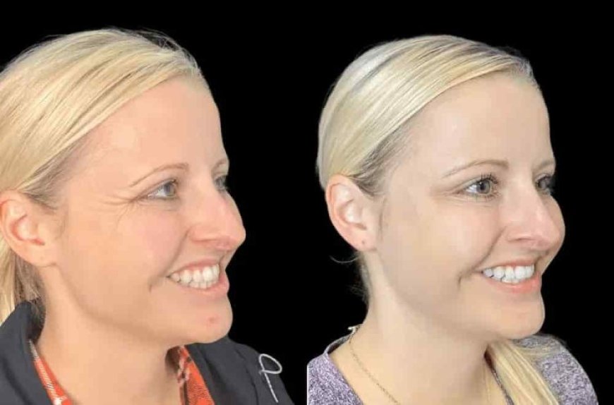 The Power of Subtle Enhancement Through Botox Treatments in Dubai