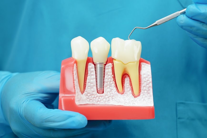 What to Expect During a Dental Crown Appointment in Garland, TX