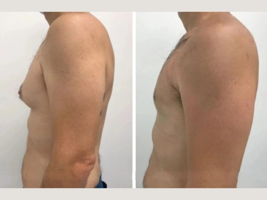 The Best Gynecomastia Surgeons in dubai: Why Their Skills Matter