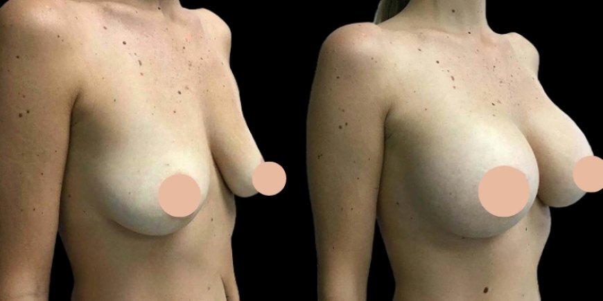 How Dubai Became a Hotspot for Breast Augmentation