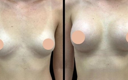 Breast Augmentation Surgery in Dubai: How to Choose the Right Implants for Your Body Type