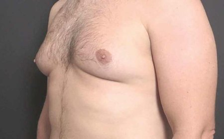 What Impacts Gynecomastia Costs in Urban Settings