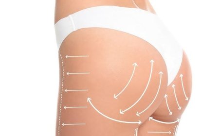 How Butt Fat Transfer Surgery in Dubai Can Improve Your Confidence
