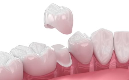 Reasons You Might Need a Dental Crown Dubai Treatment