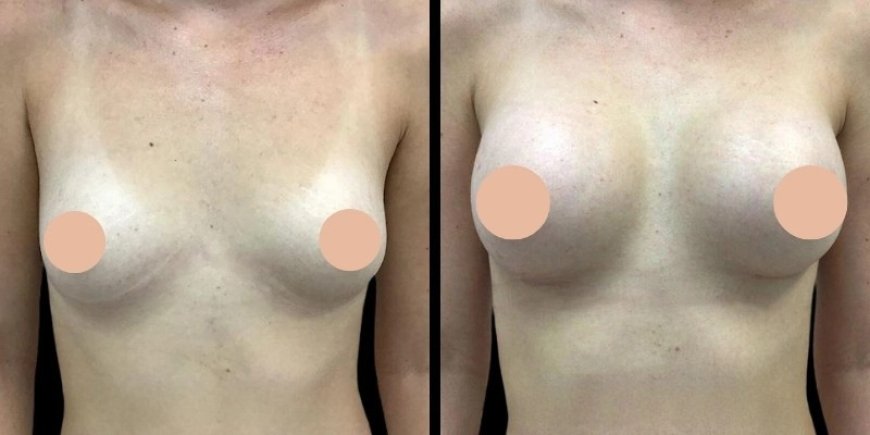 Breast Augmentation Surgery in Dubai: How to Choose the Right Implants for Your Body Type