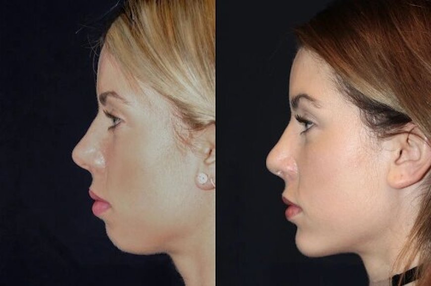 Best Aesthetic Clinics in dubai for Chin Fillers: What You Should Know About Injection Techniques
