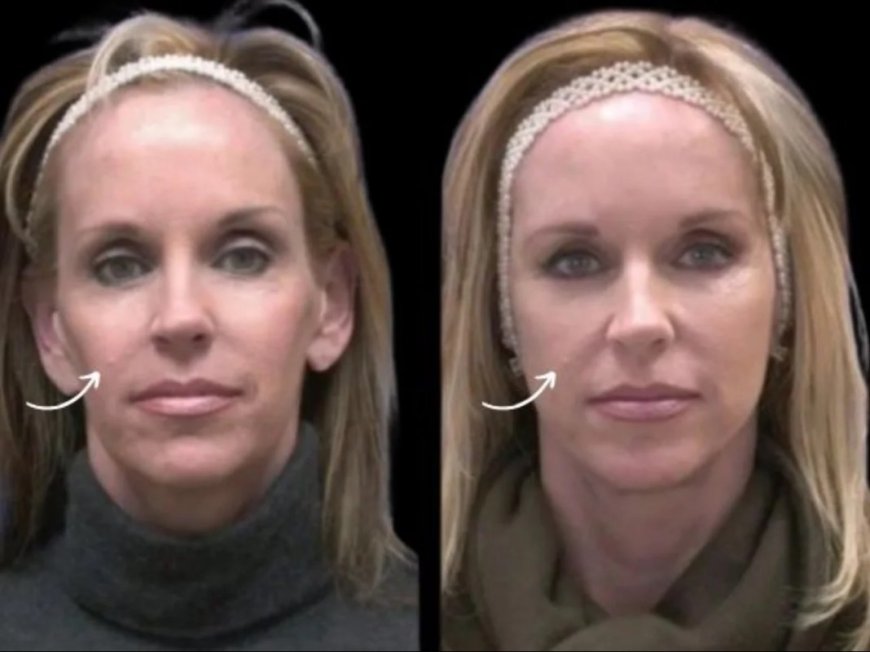 Best Plastic Surgeons in Dubai: Sculptra Fillers & Virtual Reality Before/After